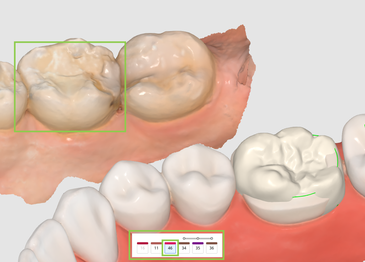 prep_tooth_data_arrangement__3